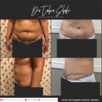 Tummy Tuck