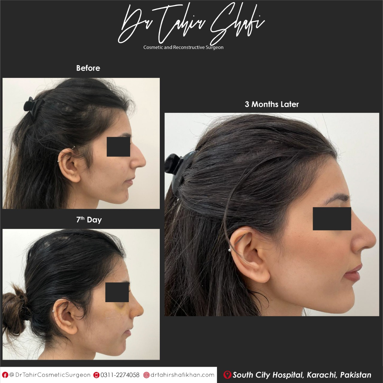 Rhinoplasty