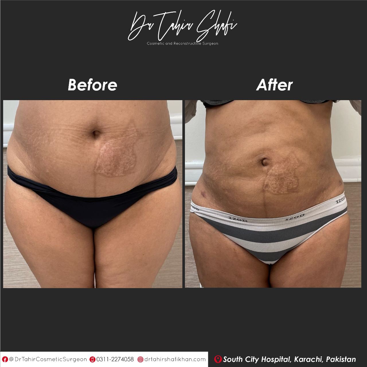 Tummy Tuck