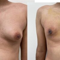 GYNECOMASTIA